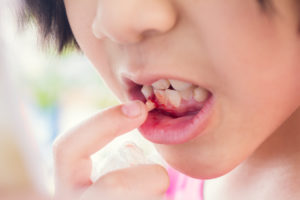 Close up of a child showing her parent her dental injury